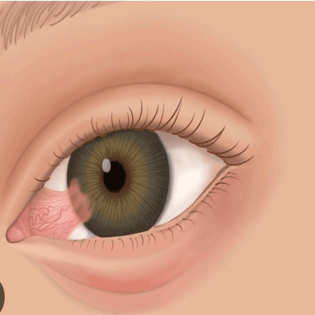 Pterygium 