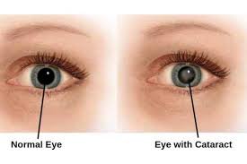 cataract