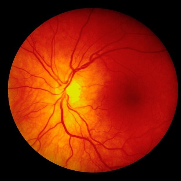 Retina & Vitreous