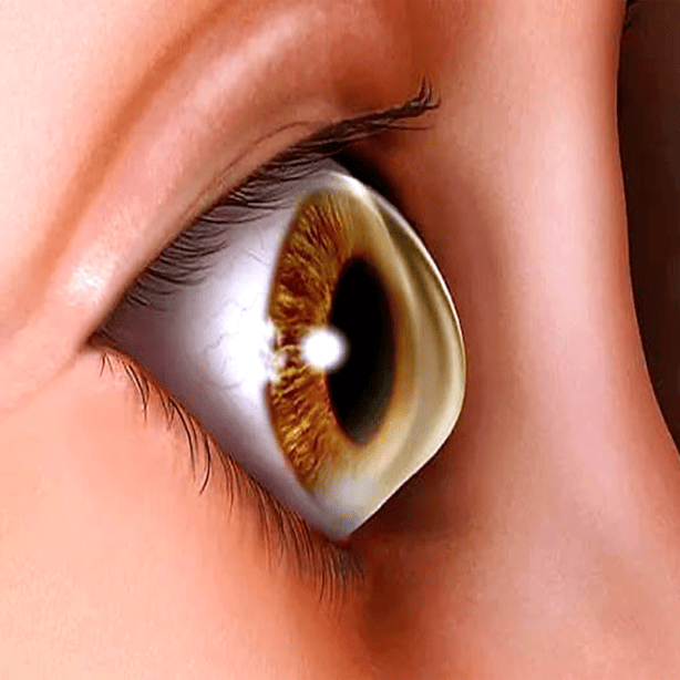 Keratoconus