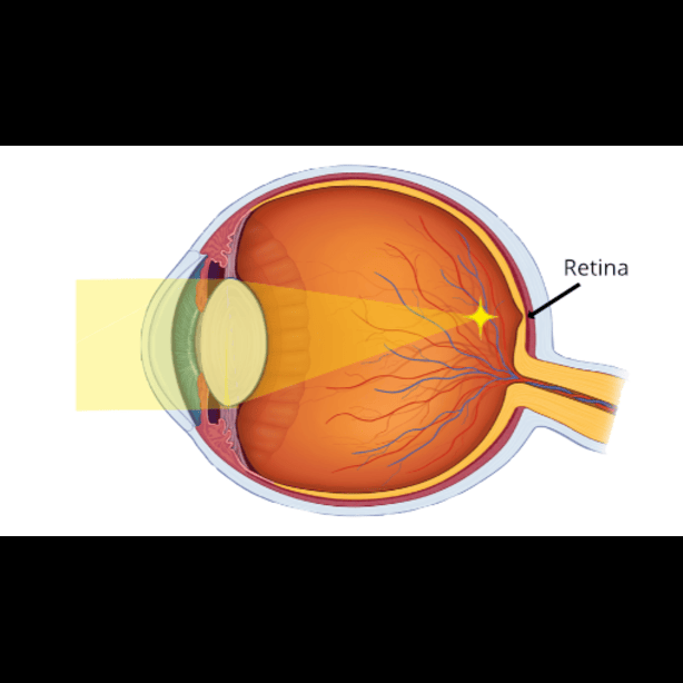 Refractive Error Correction